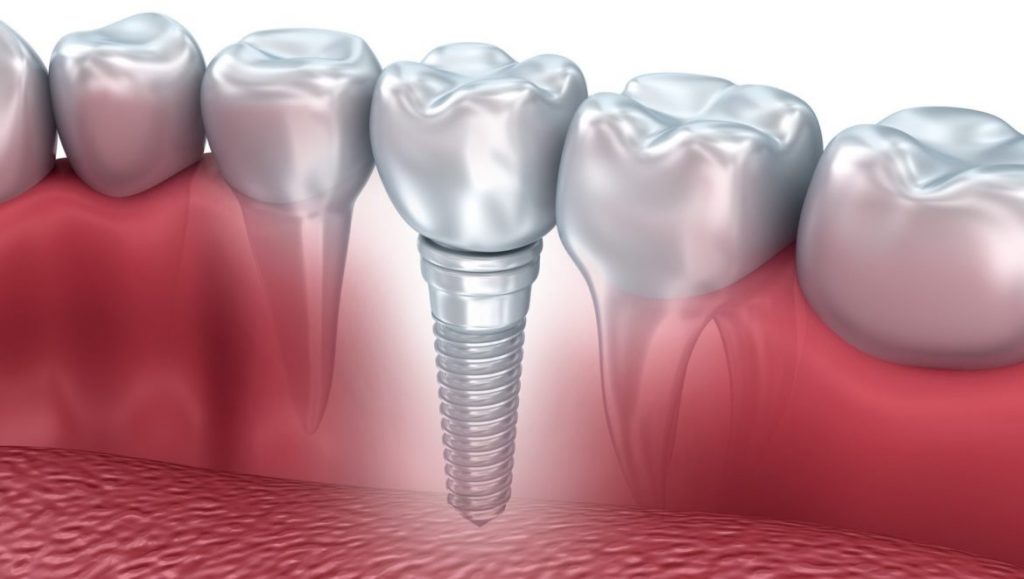 cand avem nevoie de implant dentar